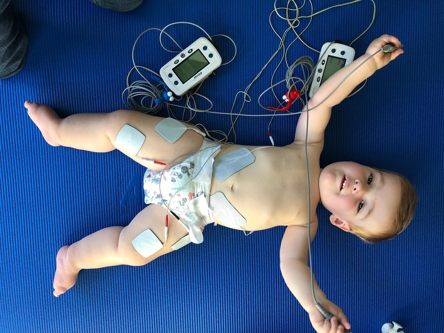What is Spinal Stimulation?
