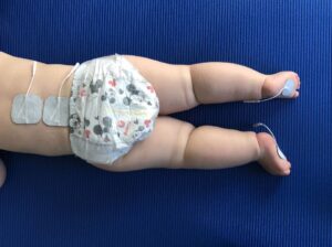 Child Face Down with Electrodes